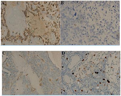 Prognostic Enigma of Pancreatic Solid Pseudopapillary Neoplasm: A Single-Center Experience of 63 Patients